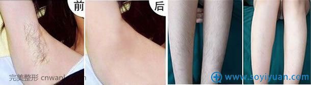 佛山蘇李秀英冰點脫毛<a href='/tag_qianhouduibi.html'>前后對比</a>照片 佛山蘇李秀英冰點脫毛前后對比照片