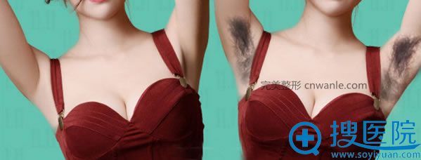 佛山蘇李秀英醫(yī)院冰點脫腋毛 佛山蘇李秀英醫(yī)院冰點脫腋毛