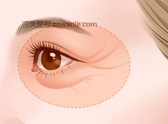 電波拉皮有什么樣的效果？