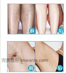 脫毛<a href='/tag_qianhouduibi.html'>前后對比</a>照