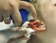 耳畸形矯正術(shù)適應(yīng)癥