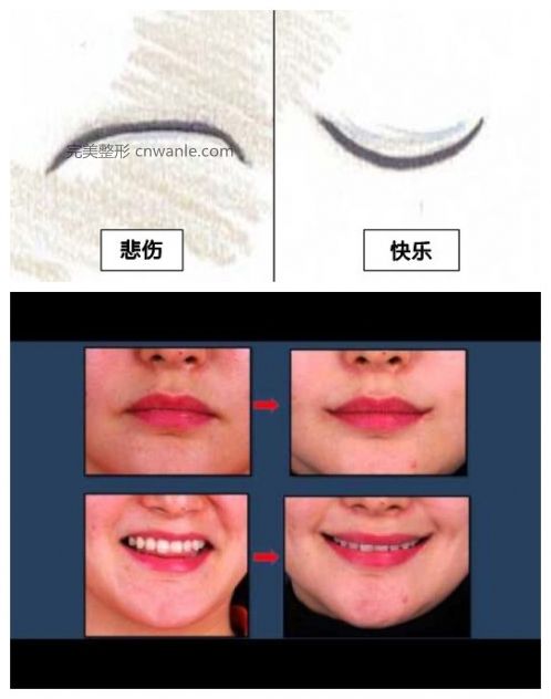 微笑也可定格 韓國(guó)流行“嘴角上揚(yáng)”手術(shù)