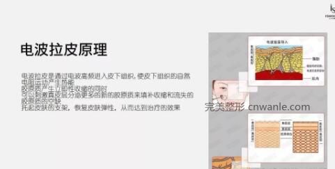 電波拉皮？是個(gè)什么鬼