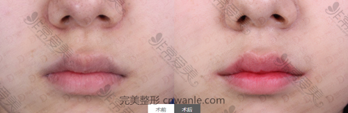 女神醫(yī)院唇部整形案例對比