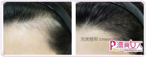  半永久紋發(fā)際線(xiàn)和發(fā)際線(xiàn)種植哪一種好？