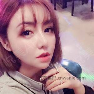 厚唇改薄術(shù)后220天_嘴角上揚術(shù)術(shù)后220天_M唇手術(shù)術(shù)后220天_唇形矯正術(shù)后220天_唇型美化術(shù)后220天_口唇整形術(shù)后220天_Ceci老姐分享圖片5