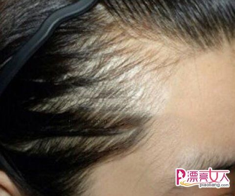 半永久紋發(fā)際線(xiàn)和發(fā)際線(xiàn)種植哪一種好?