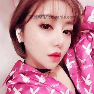 厚唇改薄術(shù)后220天_嘴角上揚術(shù)術(shù)后220天_M唇手術(shù)術(shù)后220天_唇形矯正術(shù)后220天_唇型美化術(shù)后220天_口唇整形術(shù)后220天_Ceci老姐分享圖片4