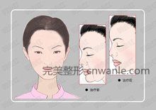 電波拉皮原理圖5