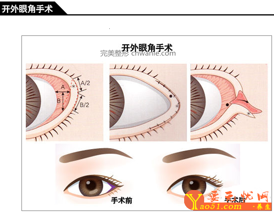 做手術(shù)開眼角眼睛會(huì)變大嗎