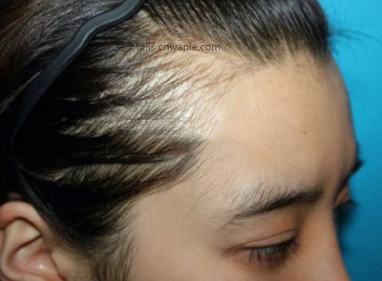 <a href='/tag_zhifa51.html'>植發(fā)</a>際線和紋發(fā)際線哪個效果更好?
