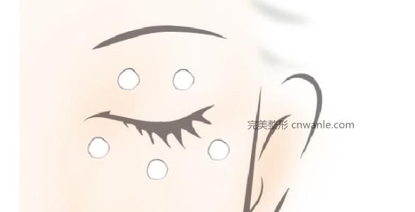 開眼角手術需要多長時間的恢復期