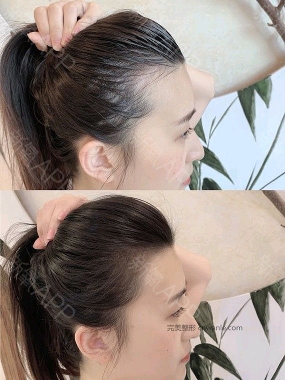 半永久紋發(fā)際線