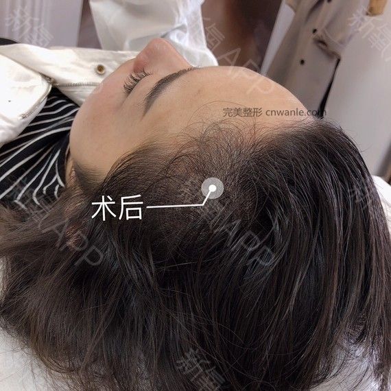 半永久紋發(fā)際線