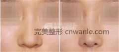 荊州是如何進(jìn)行鼻尖整形的呢?
