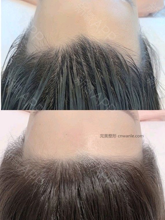 半永久紋發(fā)際線