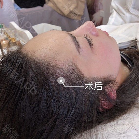 半永久紋發(fā)際線