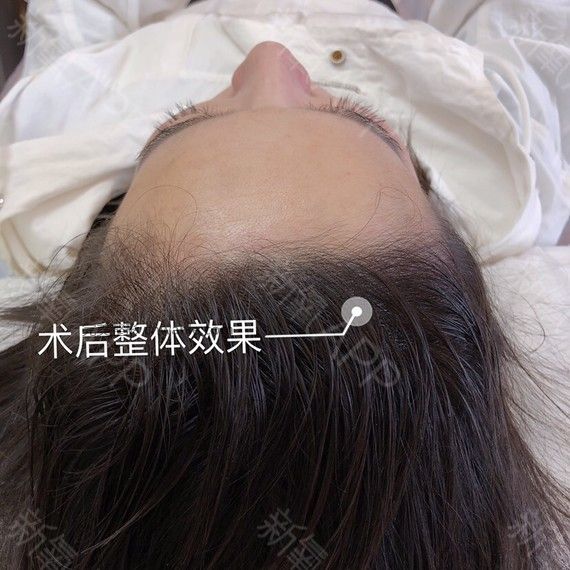 半永久紋發(fā)際線
