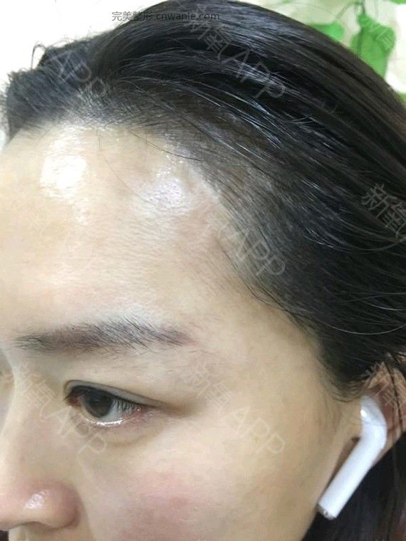 半永久紋發(fā)際線 半永久紋發(fā)際線