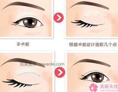 <a href='/tag_bijianzhengxingshu.html'>鼻尖整形術(shù)</a>5種鼻尖狀況的矯正方法