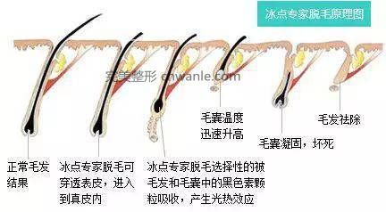 冰點(diǎn)脫毛比激光脫毛會有何優(yōu)勢 激光脫毛和冰點(diǎn)脫毛有何區(qū)別