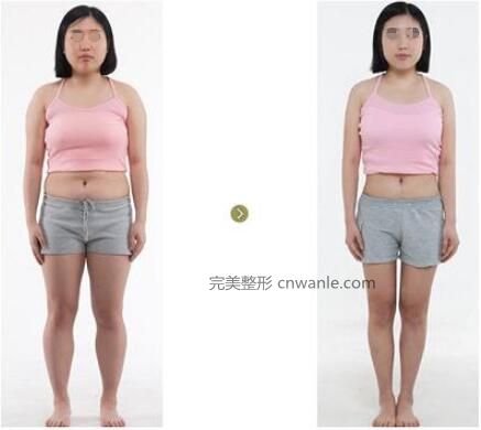 大腿<a href='/tag_xizhijianfei25.html'>吸脂減肥</a>手術(shù)會不會反彈呢