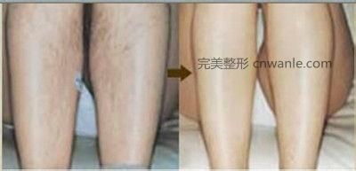 冰點脫毛幾個月會長出來