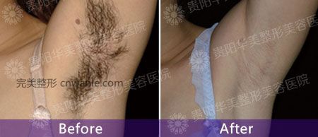 女神和女漢子，就差一次脫毛的距離！