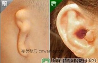 耳朵再造手術(shù)前后對(duì)比圖