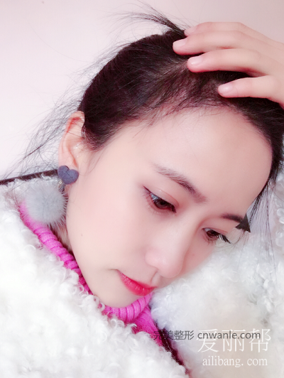 發(fā)際線種植效果好嗎？案例分享