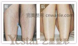 成都藝星激光脫腿毛會痛嗎