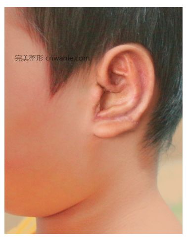 肋軟骨耳再造二期手術(shù)