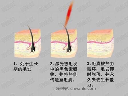 冰點脫毛 冰點脫毛