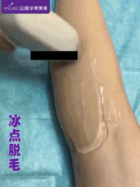 冰點(diǎn)脫毛