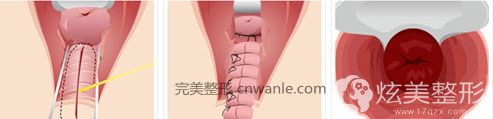 Miss陰道整形手術(shù)韓國好手藝婦科 Miss陰道整形手術(shù)韓國好手藝婦科