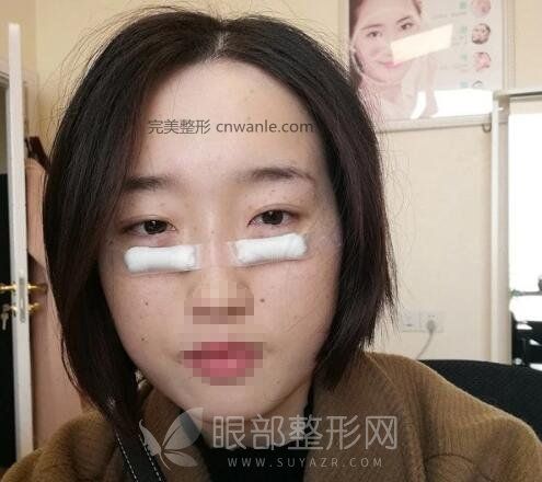 電波拉皮去眼袋效果太好了吧！這是什么神仙技術(shù)！