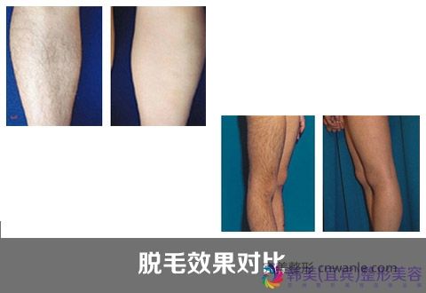 冰點(diǎn)脫毛優(yōu)勢大攻略