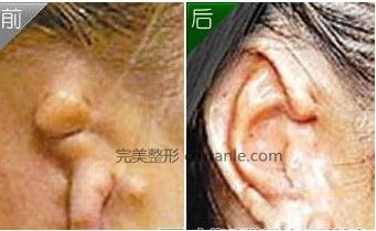 耳朵再造術(shù)后注意事項(xiàng)