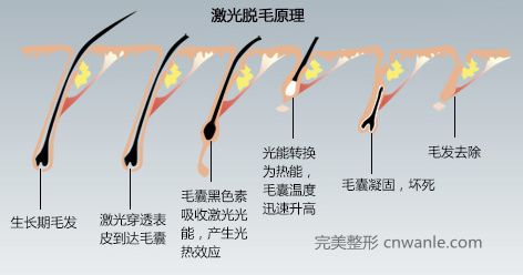 冰點(diǎn)無(wú)痛 脫毛儀脫毛原理
