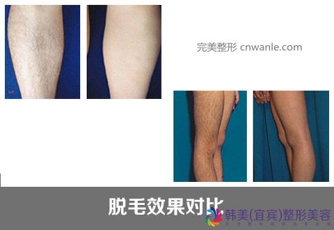 冰點(diǎn)脫毛優(yōu)勢(shì)是什么
