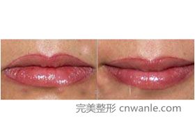 南昌邦林部口角成形手術(shù)案例