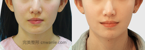 江南三星嘴角整形案例對比