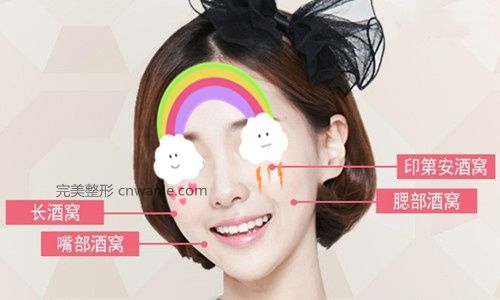 酒窩成形術的效果如何