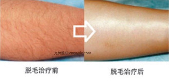 冰點(diǎn)脫毛的優(yōu)點(diǎn)包括哪些