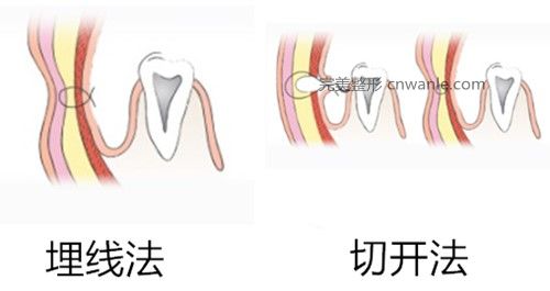 韓國酒窩成形術方法示意圖