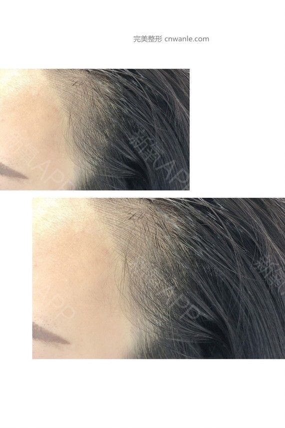 半永久紋發(fā)際線