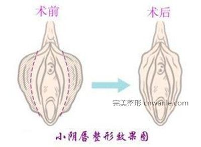 韓國好手藝陰唇<a href='/tag_zhengxingshoushu5.html'>整形手術(shù)</a>對比