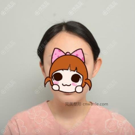韓國普羅菲耳招風耳矯正真人案例