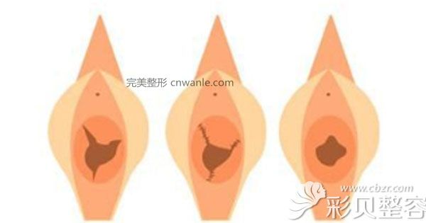 處女膜修復(fù)前后效果對比圖