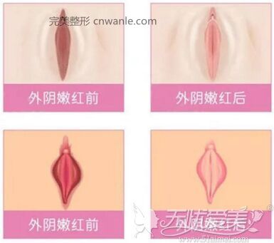 杭州時(shí)光陰唇<a href='/tag_piaohong.html'>漂紅</a>手術(shù) 杭州時(shí)光陰唇漂紅手術(shù)